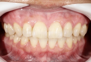 ホワイトニング前の歯の写真