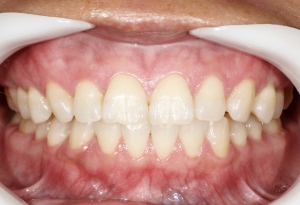 LED照射後の歯の写真