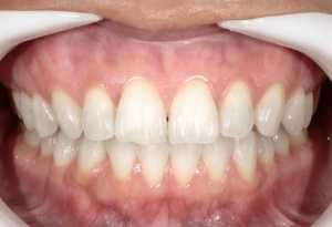 ホームホワイトニング後の歯の写真